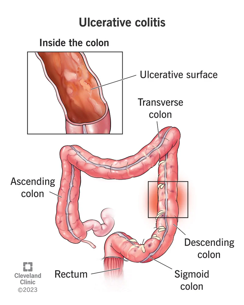 Ulcerative Colitis